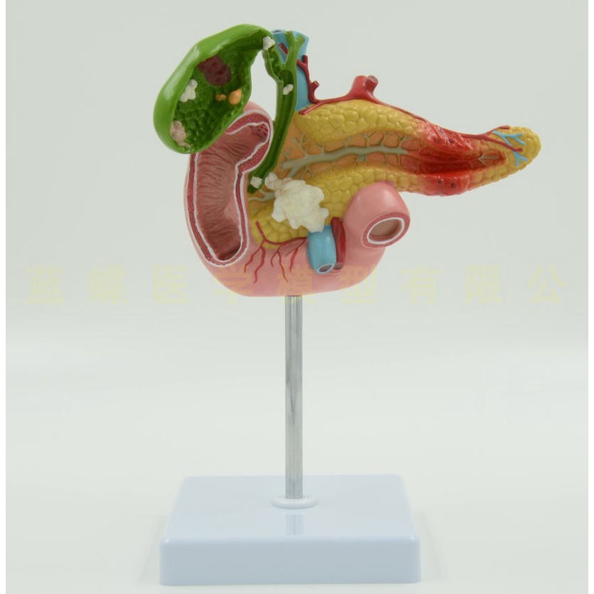 ♥ 醫學胰腺十二指腸膽囊病理模型 膽結石外科消化科系統肝膽科模型 | 蝦皮購物