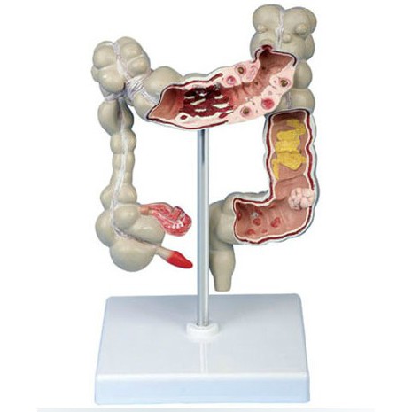 可開發票結腸病理模型結腸病變模型大腸模型腸解剖模型腸子解剖教學教具