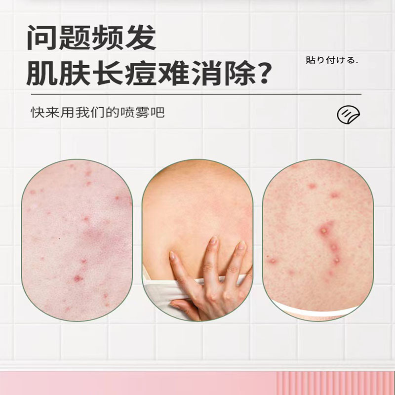 代開發票 台灣發貨 後背噴霧背痘噴霧 背後痘痘 背痘痘噴霧 背痘剋星皮膚修護 清潔 粉刺 閉口 美背 噴霧 胸前 後背痘 | 蝦皮購物