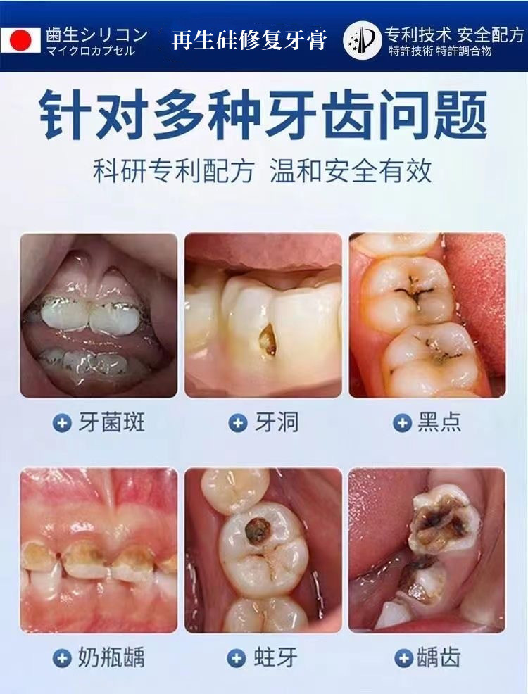 臺灣出貨 日本再生硅口腔牙膏 防護固齒 再生硅牙膏防蛀牙 益生菌牙膏 修復齲齒蛀 牙菌斑 黑點 牙漬牙裂 蛀牙 清新口氣 | 蝦皮購物
