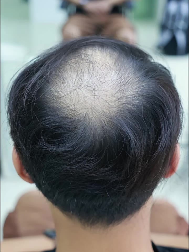 ✨️甄選髮塊✨️ 全真髮 修飾臉型 帥氣自然 無痕蓬鬆遮禿直髮 男士微分前刺摩根燙造型補髮片 增加髮量 遮白發 假髮男士