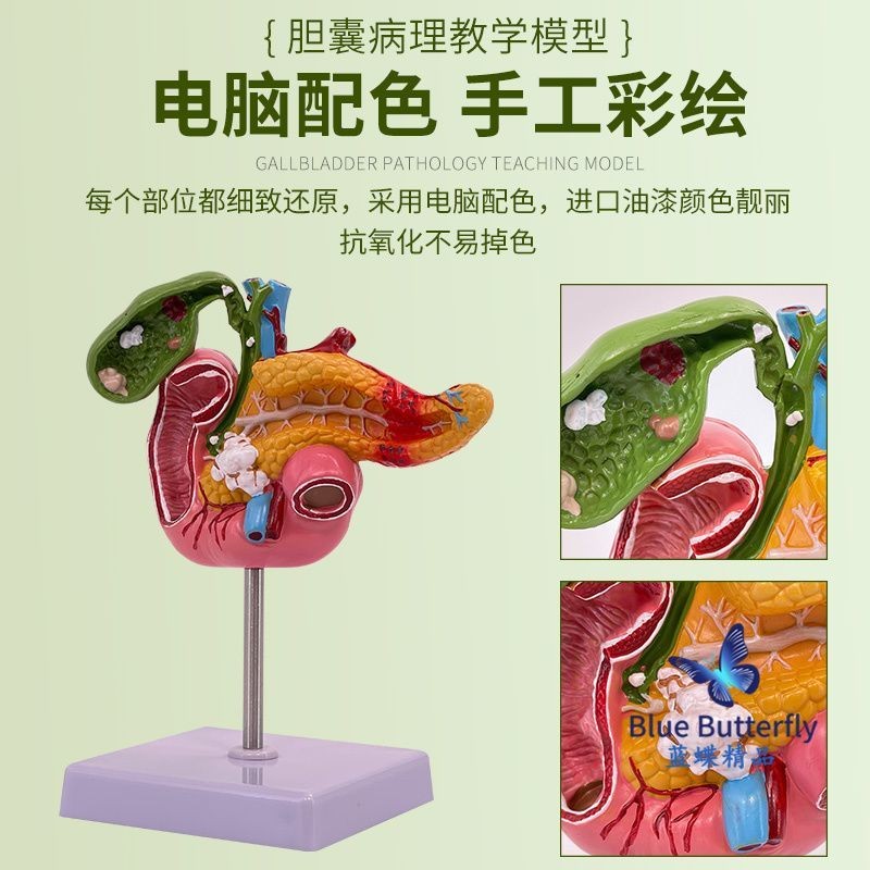 可開發票 醫學科普胰腺十二指腸膽囊病理模型 膽結石肝膽科仿真 人體模型 器官模型 敎學人體模型 人體解剖模型 | 蝦皮購物