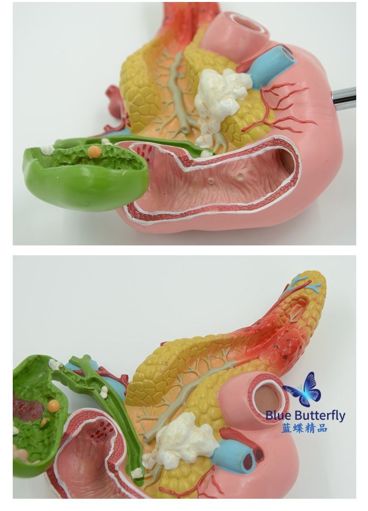 可開發票 醫學科普胰腺十二指腸膽囊病理模型 膽結石肝膽科仿真 人體模型 器官模型 敎學人體模型 人體解剖模型 | 蝦皮購物