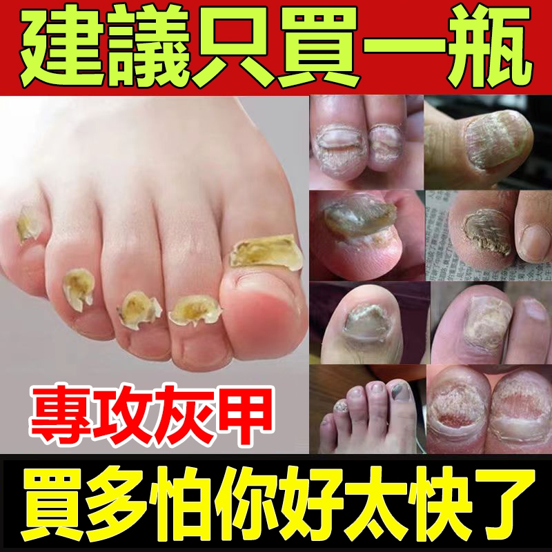 【灰甲難題】灰指甲專用液抑菌液去黃甲厚甲凍甲嵌甲修復甲床灰甲真菌治療液甲萎縮無痛換甲防反復 | 蝦皮購物