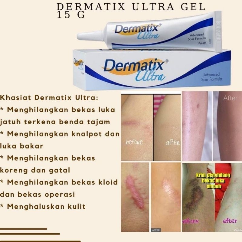 Dermatix Ultra Gel15gr/ReadyStock | 蝦皮購物