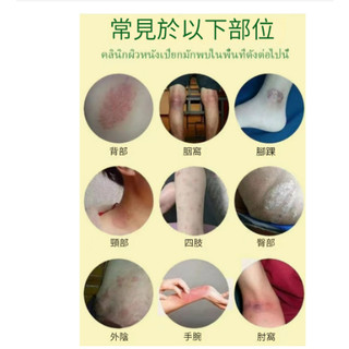 溼疹膏皮炎溼疹汗皰疹去溼毒溼癢大腿內側皮膚瘙癢止癢膏肛門溼疹 | 蝦皮購物