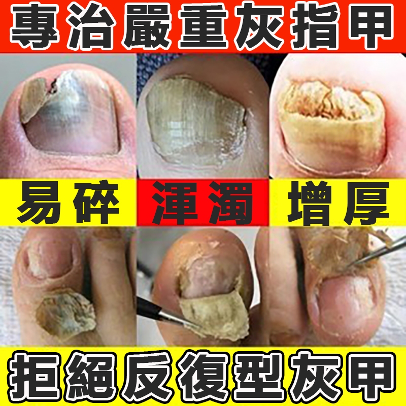 ♋重症灰甲救星♋灰指甲真菌治療液去真菌修復凍甲變色增厚甲床無懼變形灰指甲專用液去灰甲灰指甲劑灰甲水促進好甲生長脫壞甲 | 蝦皮購物