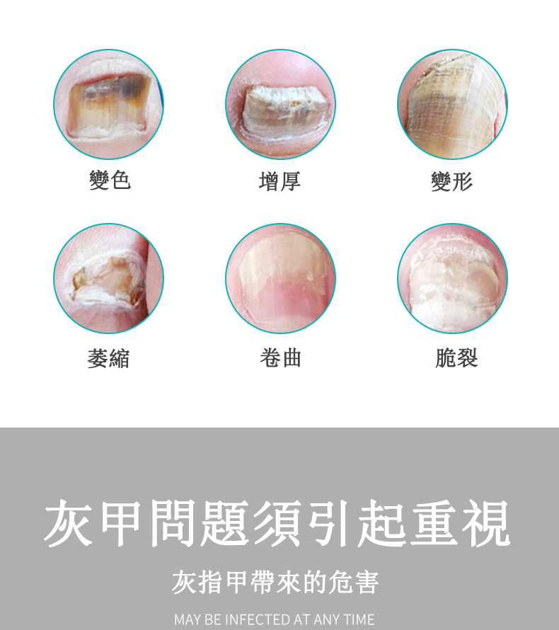 【灰甲難題】灰指甲專用液抑菌液去黃甲厚甲凍甲嵌甲修復甲床灰甲真菌治療液甲萎縮無痛換甲防反復 | 蝦皮購物
