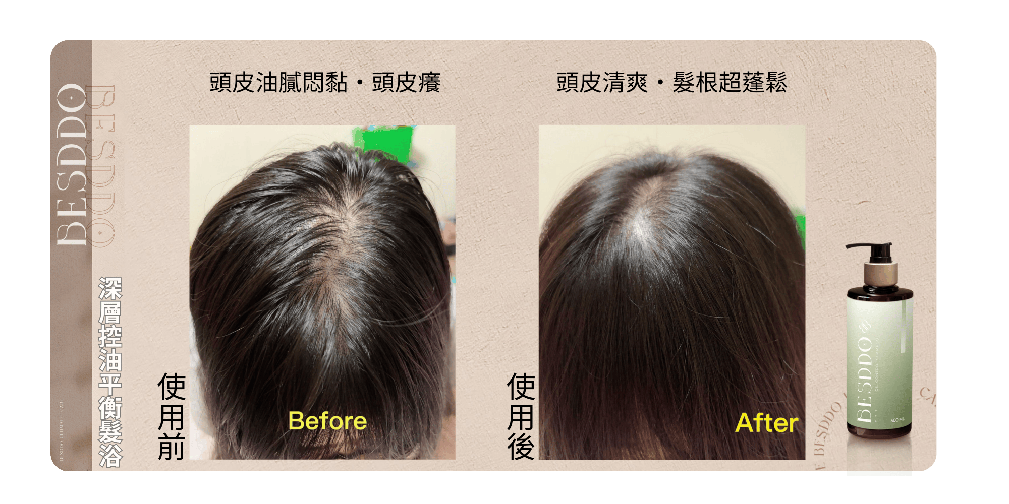 使用前，BESDDO 深層控油平衡髮浴，頭皮油膩悶黏・頭皮療，頭皮清爽•髮根超蓬鬆，使用後。